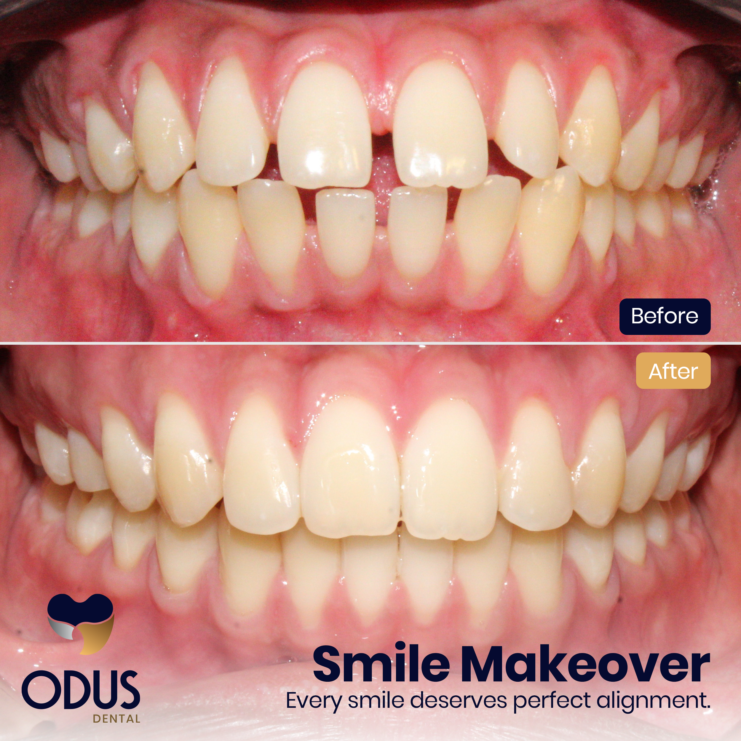 Invisalign Provider in Bangalore Happy Patient