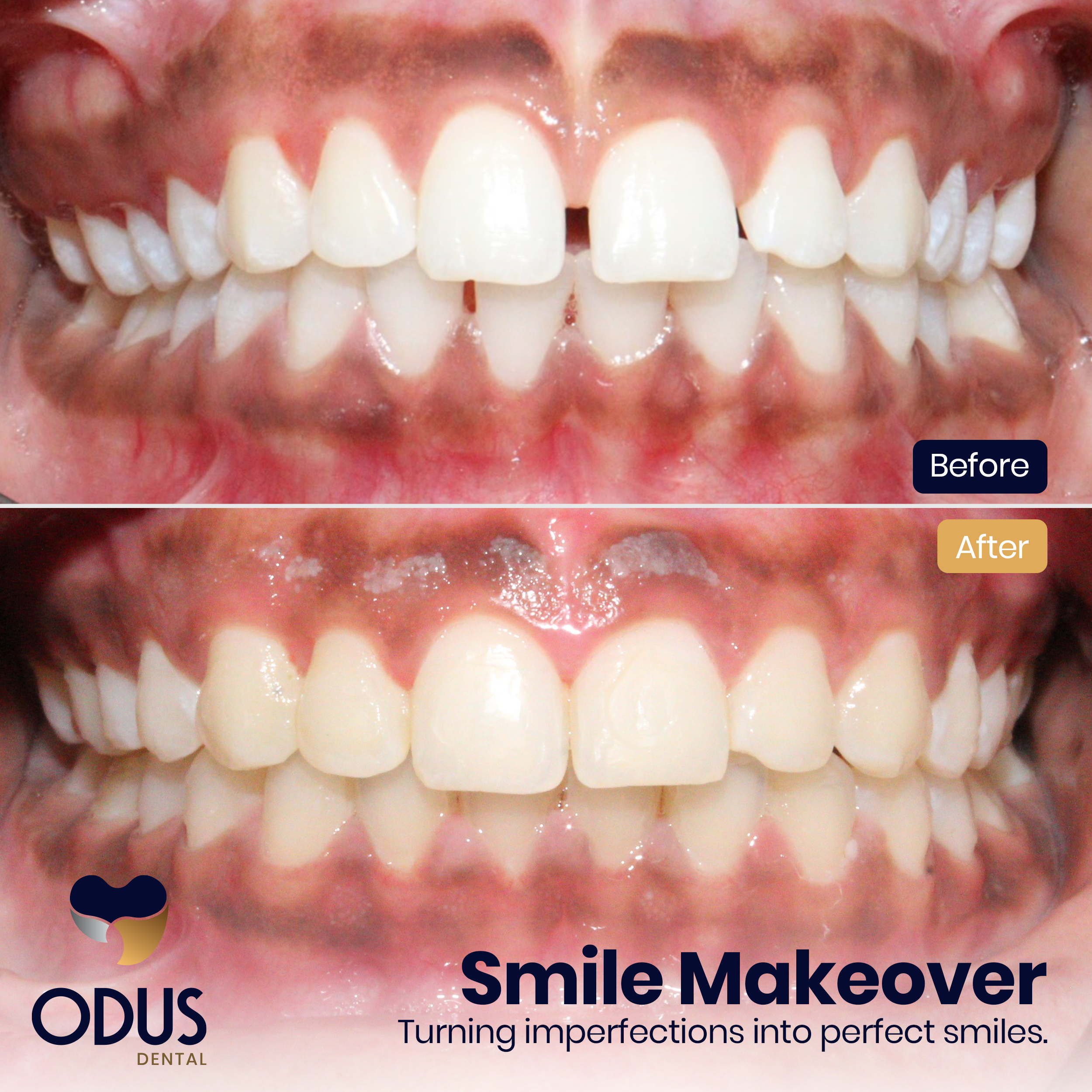 Invisalign Provider in Bangalore Happy Patient