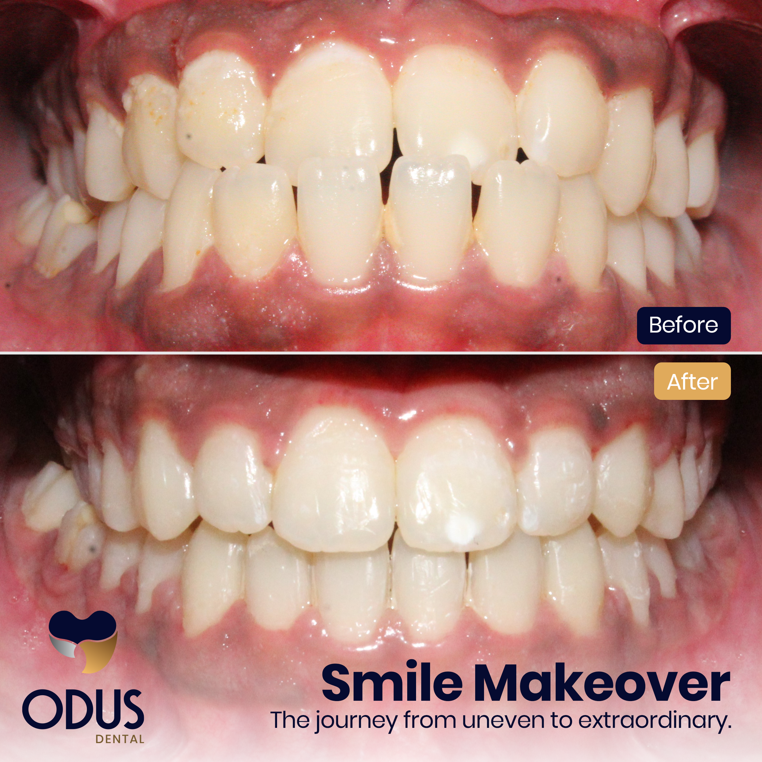 Invisalign Provider in Bangalore Happy Patient