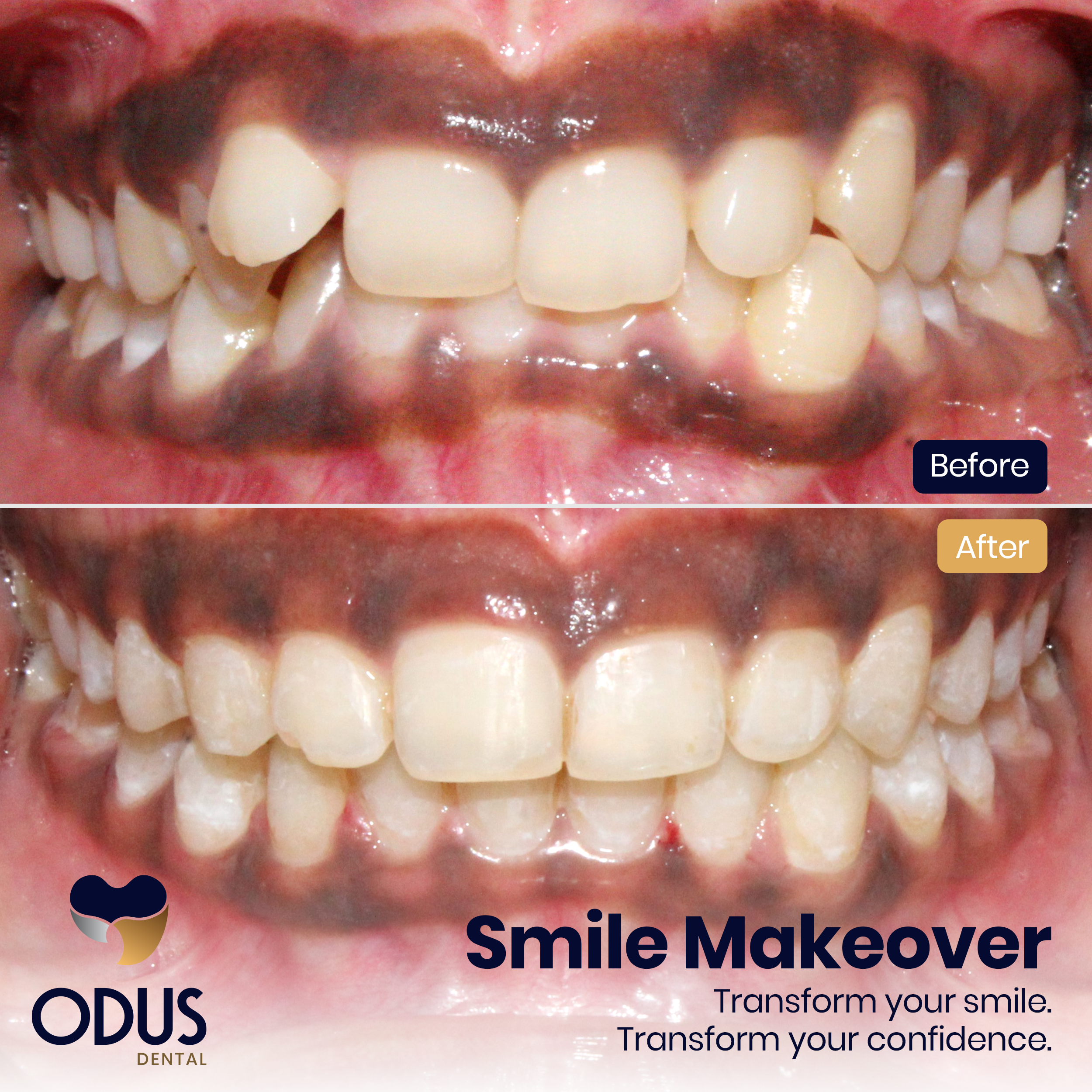 Invisalign Provider in Bangalore Happy Patient