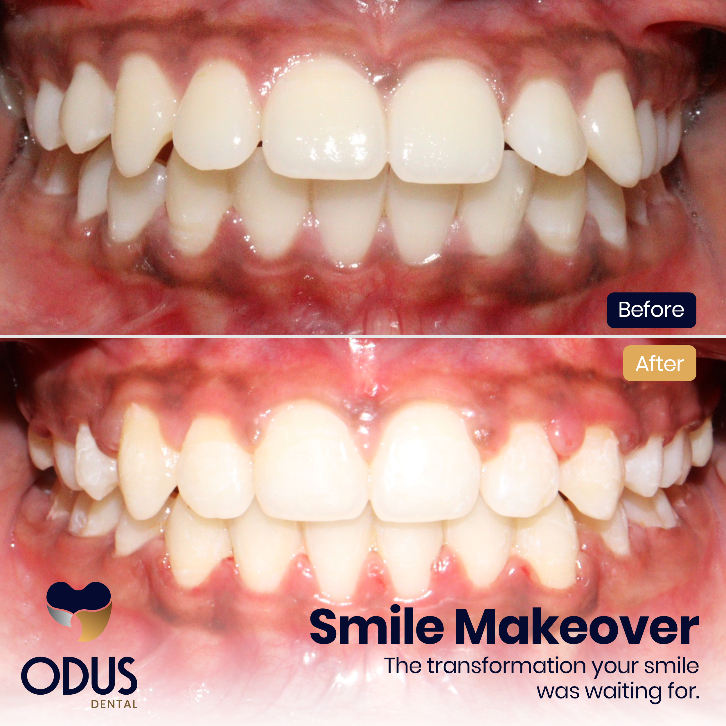 Invisalign Provider in Bangalore Happy Patient