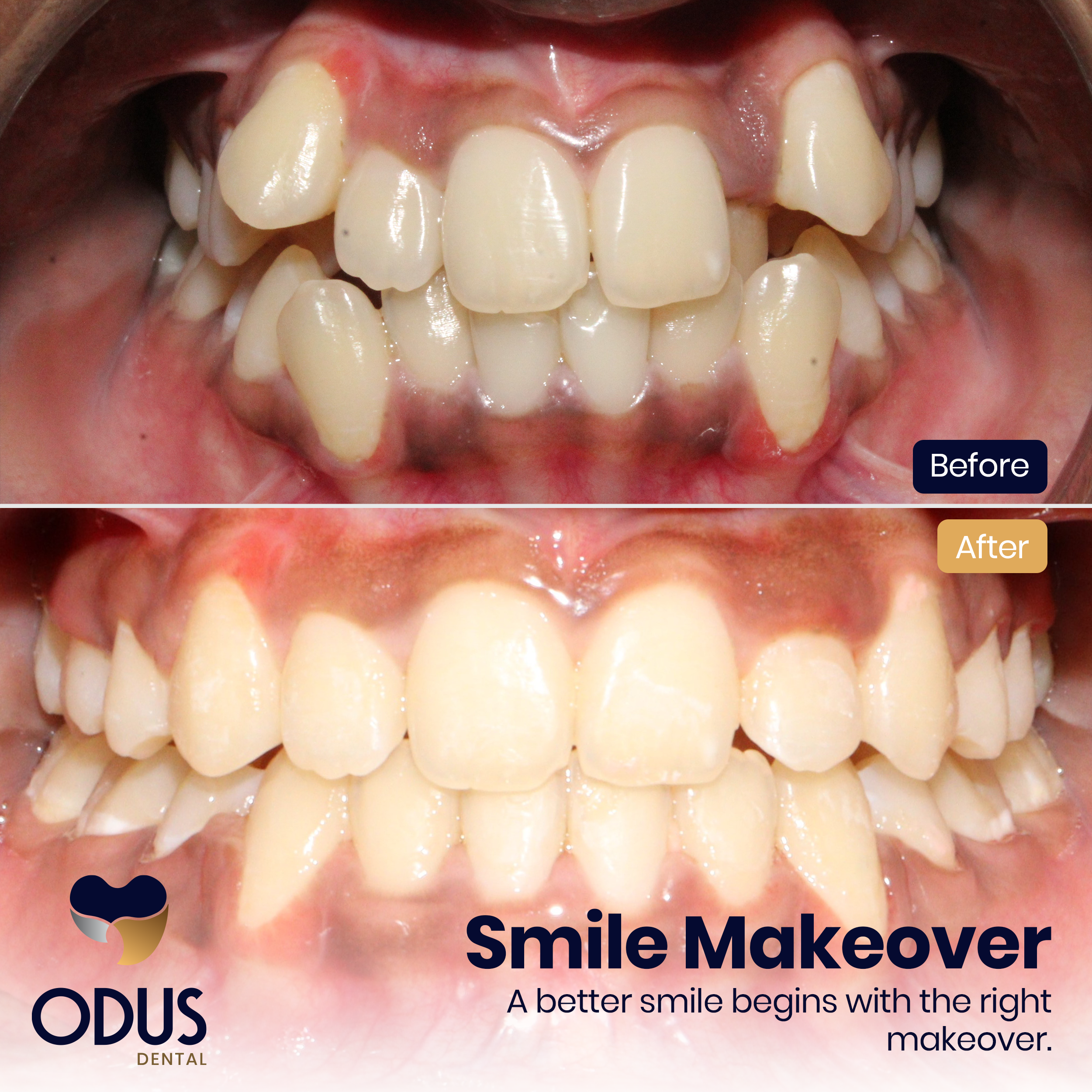 Invisalign Provider in Bangalore Happy Patient